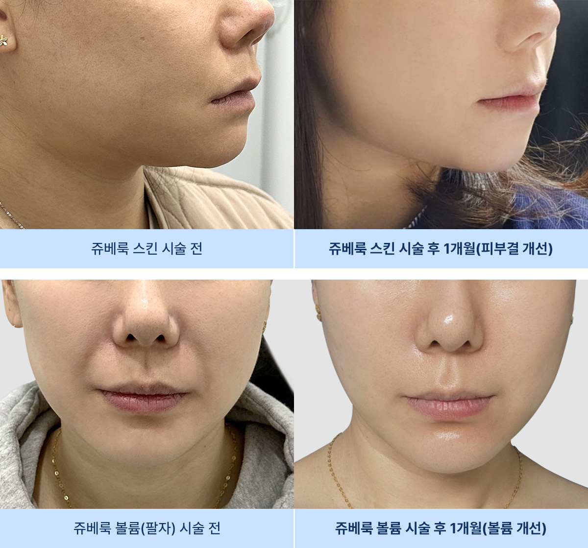 쥬베룩 스킨과 볼륨의 주요 차이점