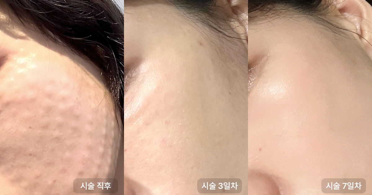 엠보 관리 방법