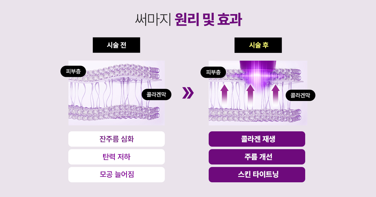 써마지의 작용 원리와 효과