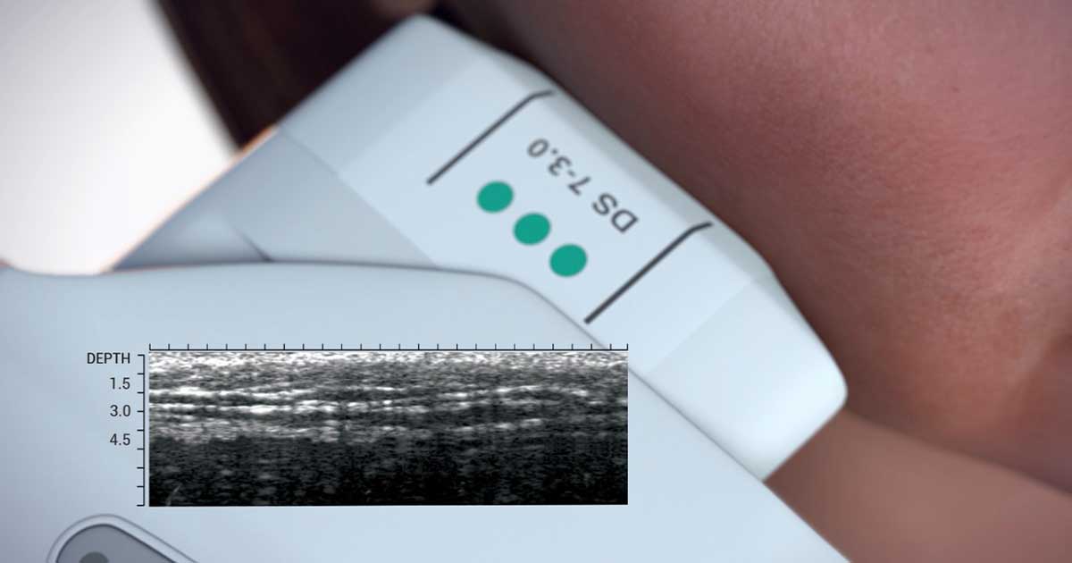 본격적인 울쎄라 시술 진행