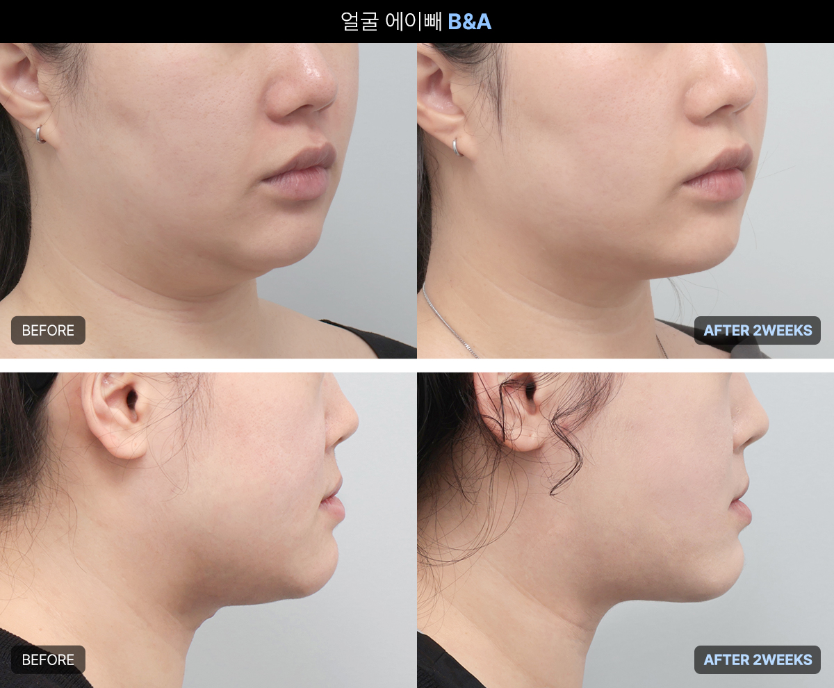 스테로이드·PPC·히알라제를 뺀 안전한 에이빼 윤곽주사