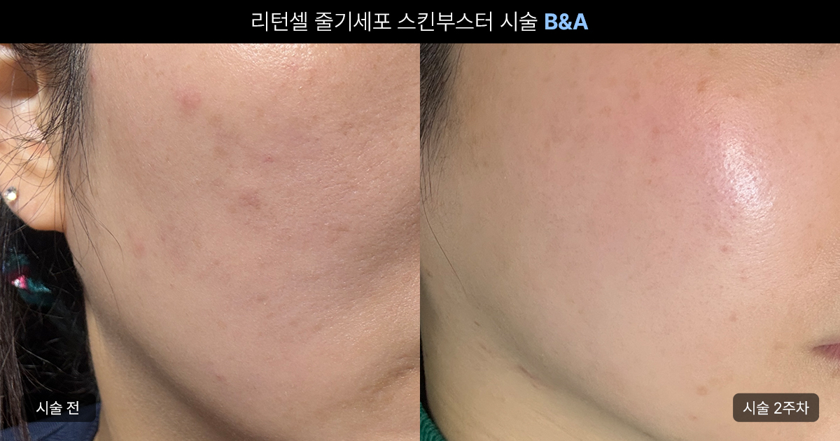 에이비 리턴셀 줄기세포 피부주사 효과