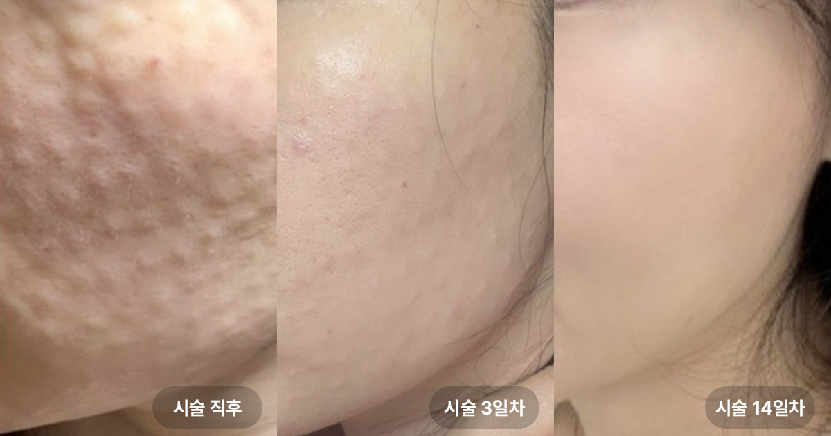 리쥬란 힐러 시술 후 경과별 효과