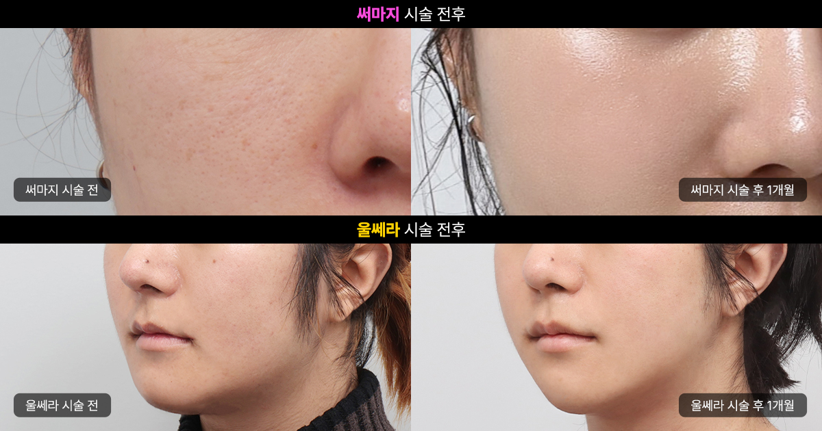 써마지 VS 울쎄라피 프라임 주요 차이점