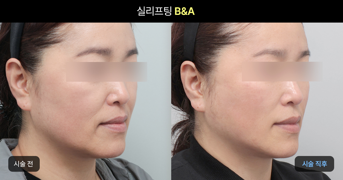 민트 실리프팅이란?