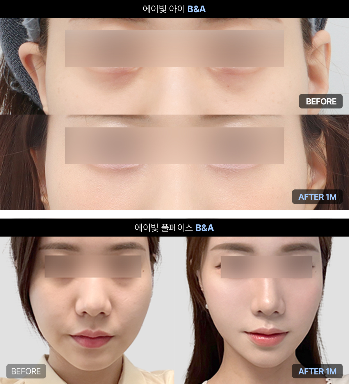 예민한 눈가부터 얼굴 전체까지 시술 가능한 에이빛주사