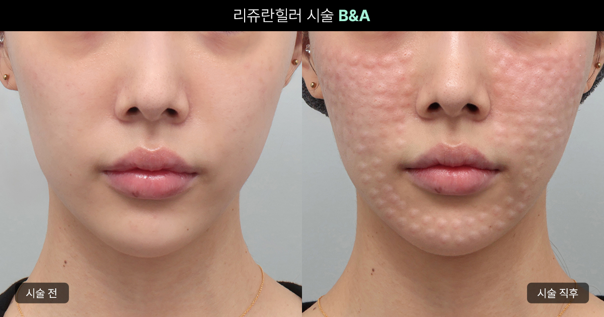 리쥬란 엠보싱 현상 원인