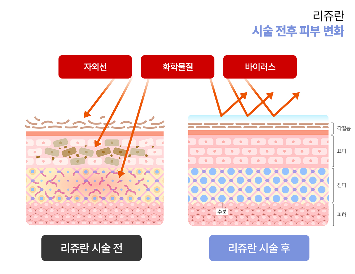 리쥬란힐러가 복원하는 피부층 변화: 각질층부터 진피까지