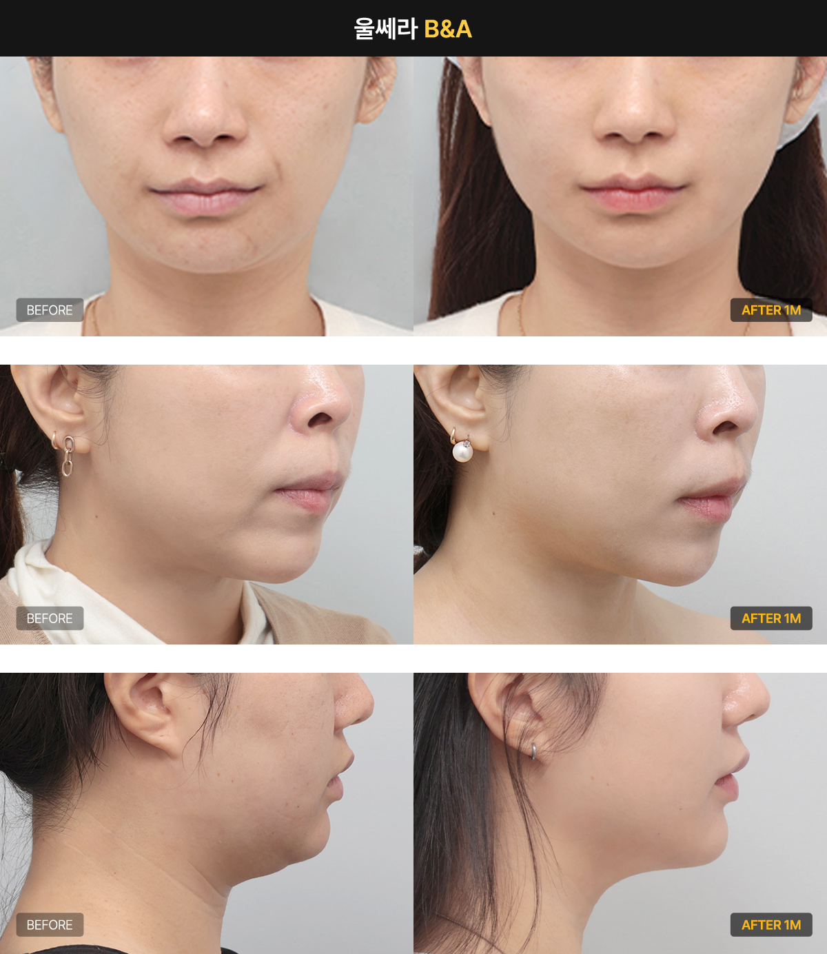 울쎄라 원리와 효과