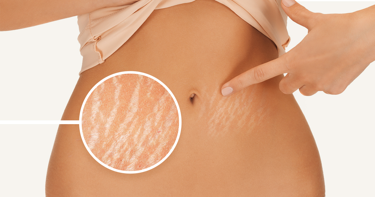 튼살 치료의 새로운 패러다임, 쥬베룩 볼륨 관련 이미지