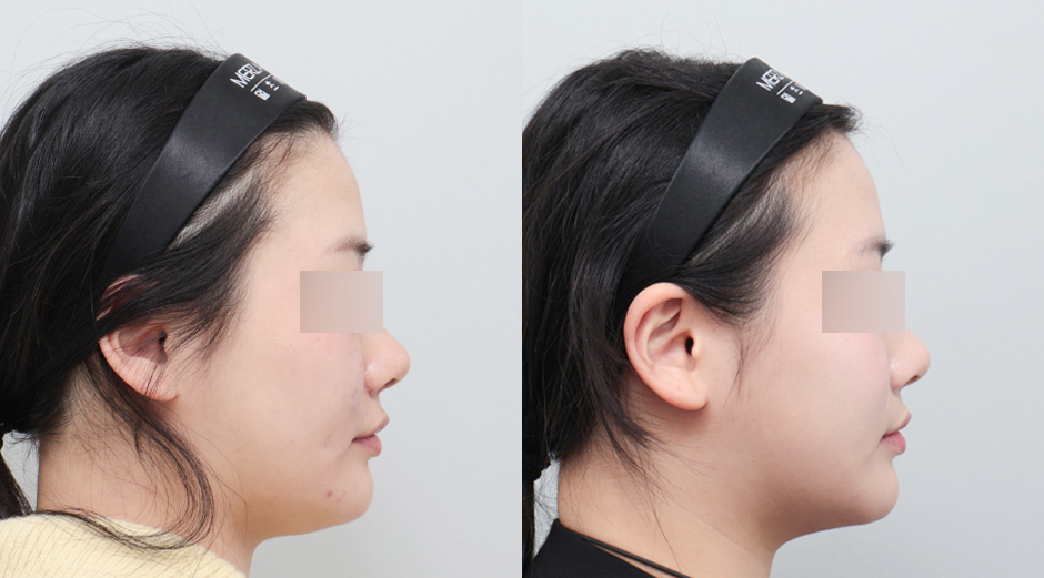 울쎄라 전후, 써마지 전후, 리쥬란 전후 시술 후 1개월