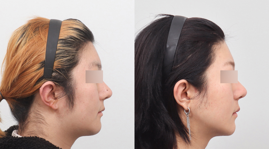 울쎄라 전후 시술 후 1개월