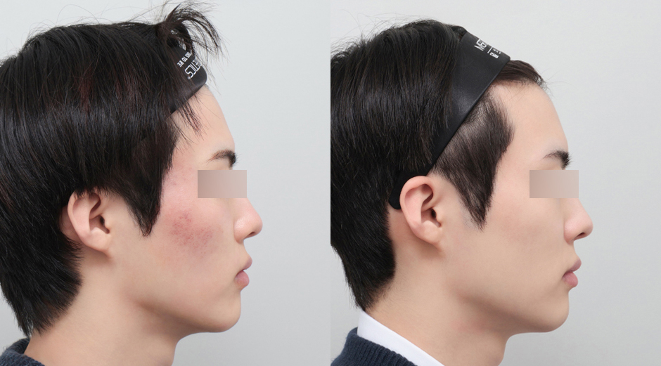 포텐자 전후, 쥬베룩 전후 시술 후 1개월