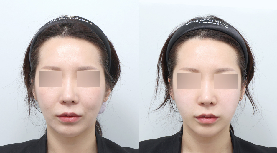 온다리프팅 (얼굴) 전후 시술 후 1개월
