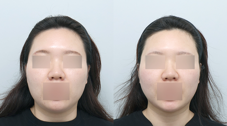 온다리프팅 (얼굴) 시술 전후
