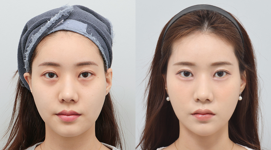 울쎄라 시술 전후, 슈링크 시술 전후, 자갈턱필러 시술 전후 정면