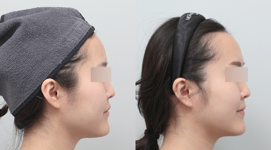 포텐자 전후, 레스노베크리스탈 전후 시술 후 1주차