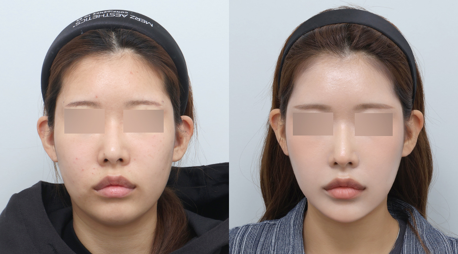 인모드 전후 시술 후 1개월