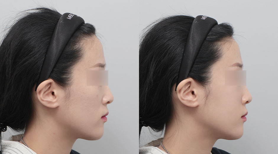 쥬베룩볼륨 전후 시술 후 1개월
