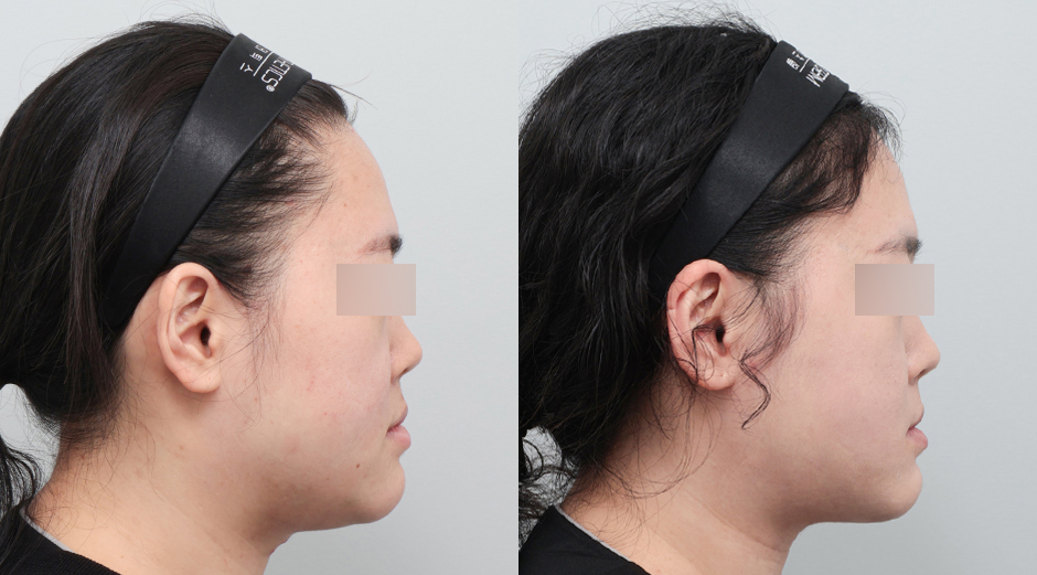 얼굴 에이빼주사 시술 전후 측면