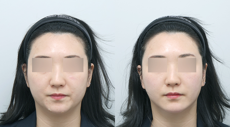 온다리프팅 (얼굴) 시술 전후
