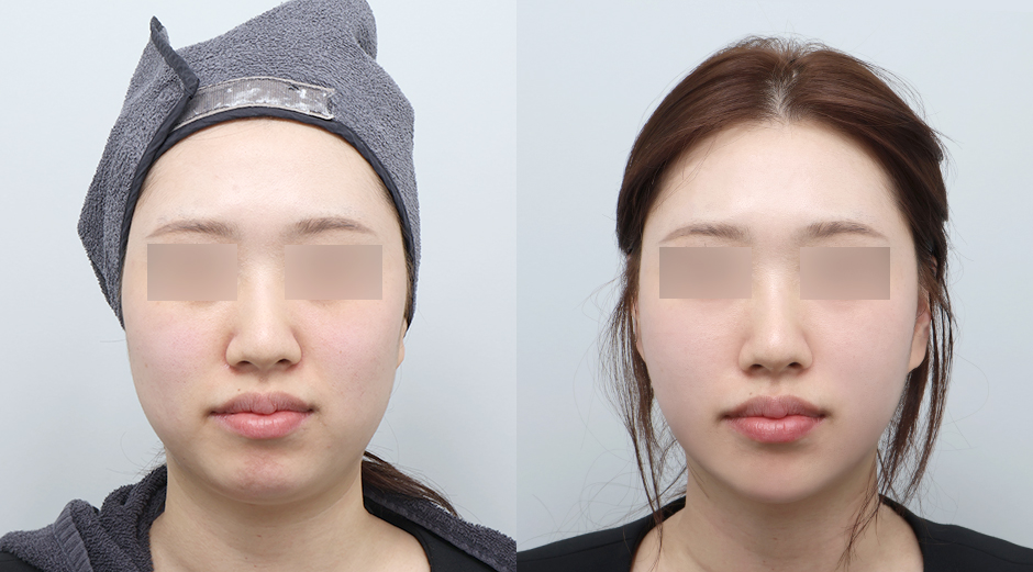 온다리프팅 (얼굴) 전후 시술 후 1개월