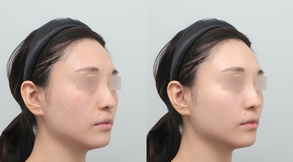 엘라비에리투오 전후 시술 후 1개월