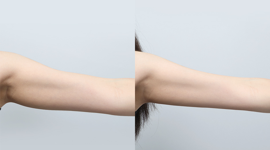 온다리프팅 (팔) 시술 전후