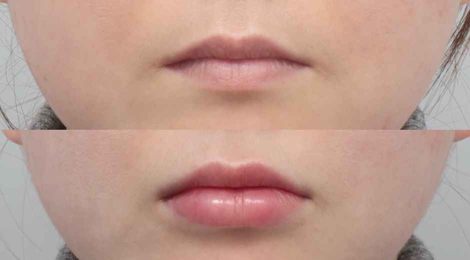 입술필러 전후 시술 후 1개월