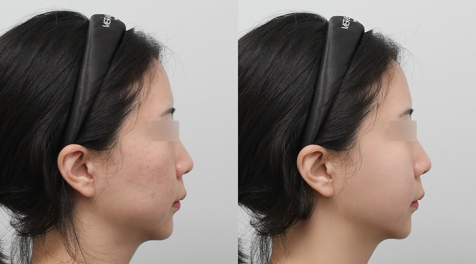 포텐자 전후, 레스노베크리스탈 전후 시술 후 1개월