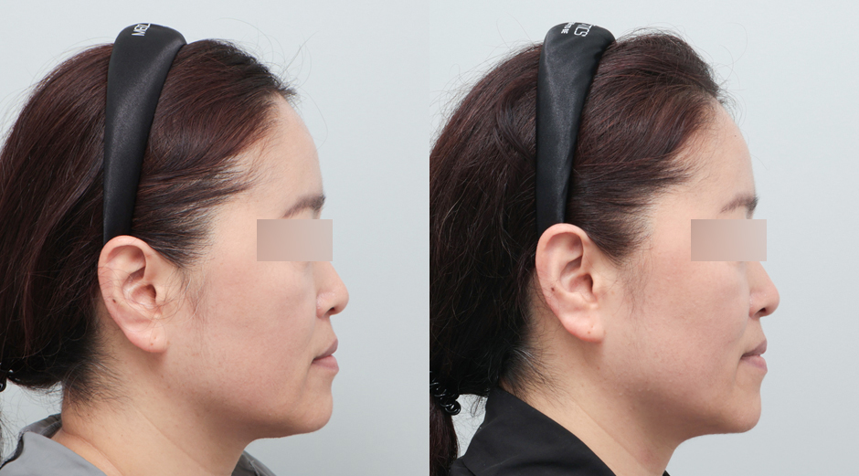 울쎄라 전후, 슈링크 전후, 레스노베 크리스탈 전후 시술 후 1개월