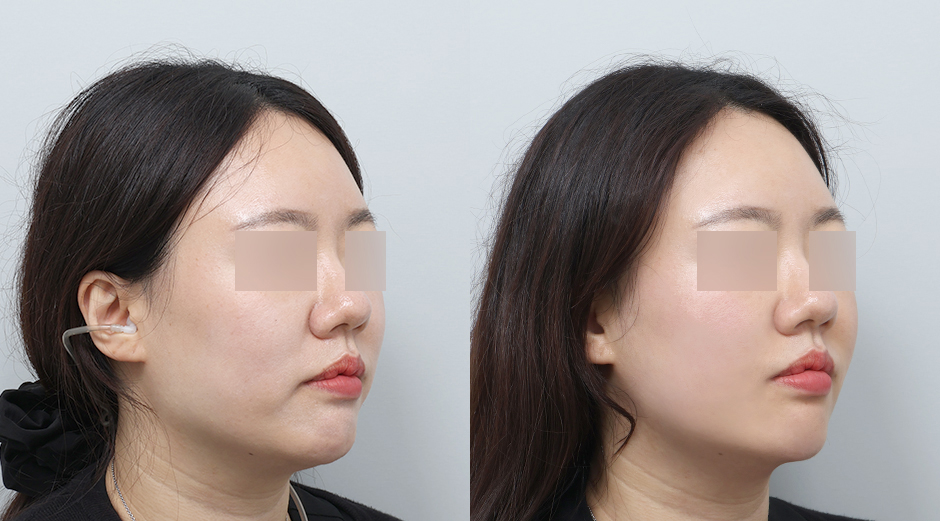 온다리프팅 (얼굴) 전후 시술 후 1개월
