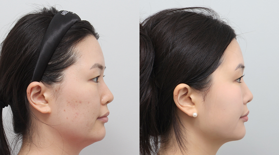 울쎄라 전후, 얼굴에이빼 전후 시술 후 1개월