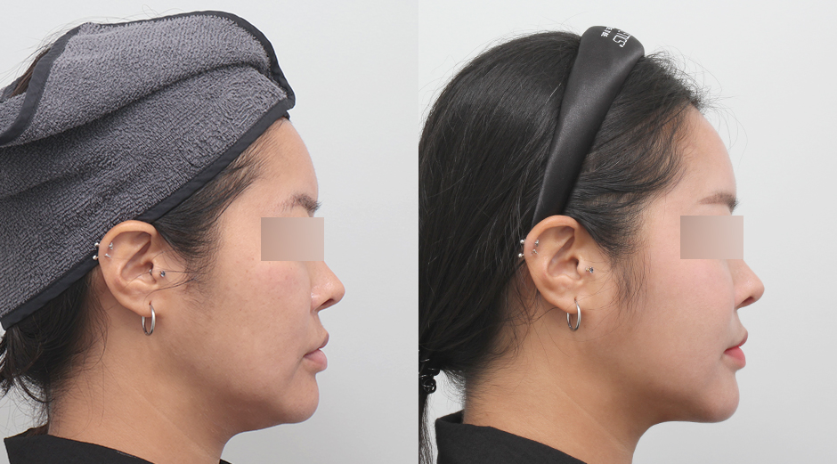 울쎄라 전후, 써마지 전후, 얼굴 에이빼주사 전후, 에이빛풀페이스 전후 시술 후 1개월