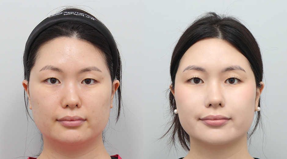 울쎄라 시술 전후, 얼굴에이빼 시술 전후