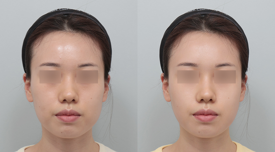 포텐자 전후, 레스노베크리스탈 전후 시술 후 1개월