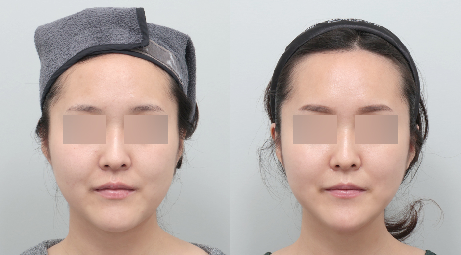 포텐자 시술 전후, 레스노베크리스탈 시술 전후