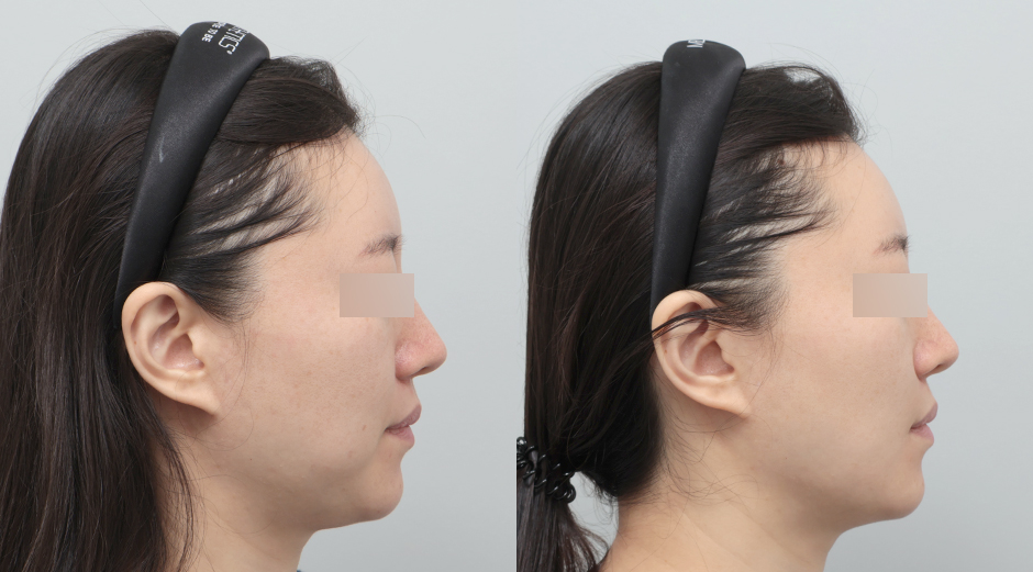 쥬베룩볼륨 시술 전후 측면