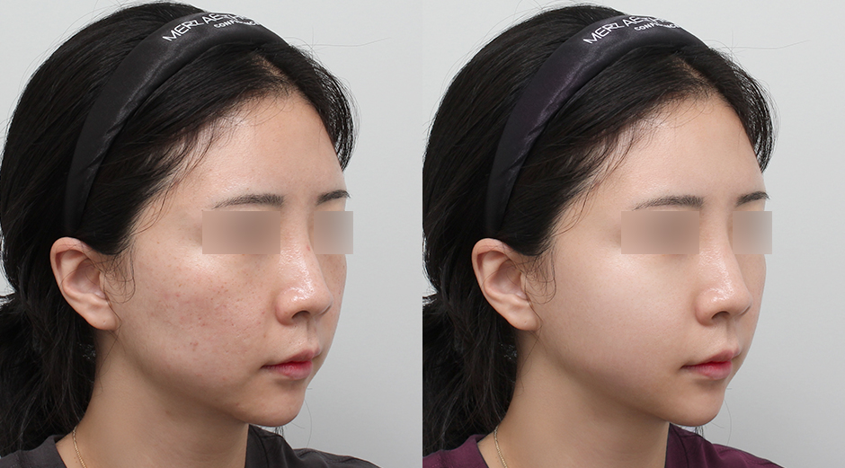 포텐자 전후, 레스노베크리스탈 전후 시술 후 1개월