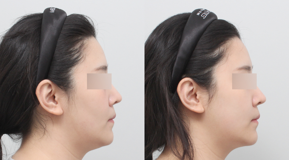 쥬베룩볼륨 시술 전후 측면