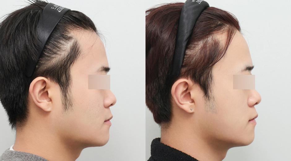 큐어젯 시술 전후, 쥬베룩 시술 전후 측면