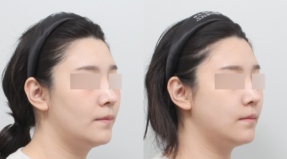 쥬베룩볼륨 시술 전후 45도