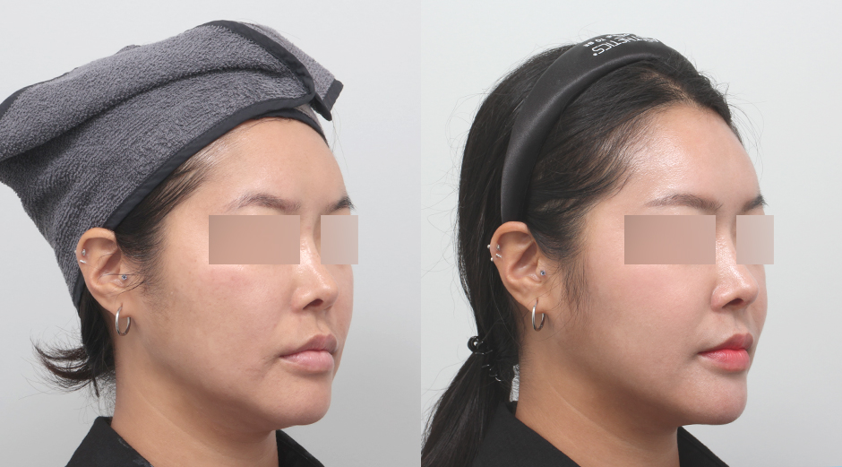 울쎄라 전후, 써마지 전후, 얼굴 에이빼주사 전후, 에이빛풀페이스 전후 시술 후 1개월