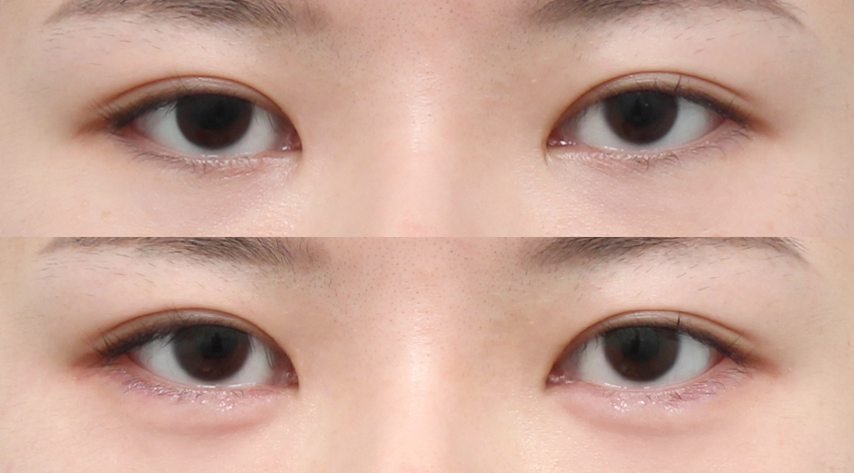 애교필러 시술 전후