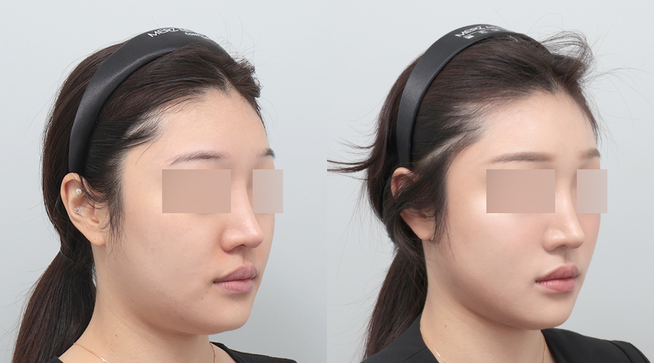 울쎄라 전후 시술 후 1개월