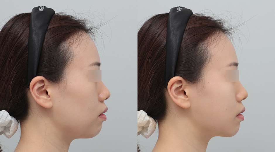 포텐자 전후, 레스노베크리스탈 전후 시술 후 1개월