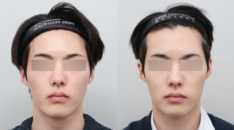 포텐자 시술 전후, 쥬베룩 시술 전후