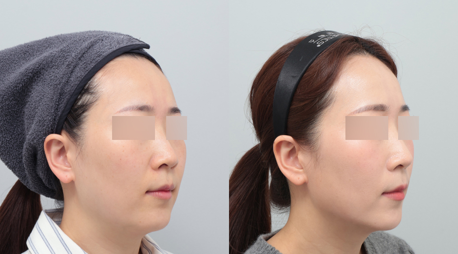 울쎄라 전후 시술 후 1개월
