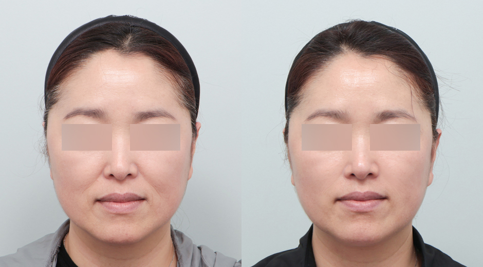 울쎄라 시술 전후, 슈링크 시술 전후, 레스노베 크리스탈 시술 전후