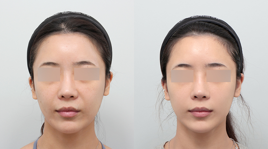 울쎄라 전후 시술 후 1개월